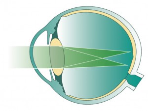 Астигматизм глаза. Лечение астигматизма