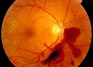 диабетич ретинопатия