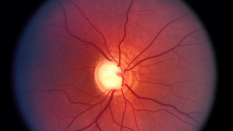 Глаукома Глаукома